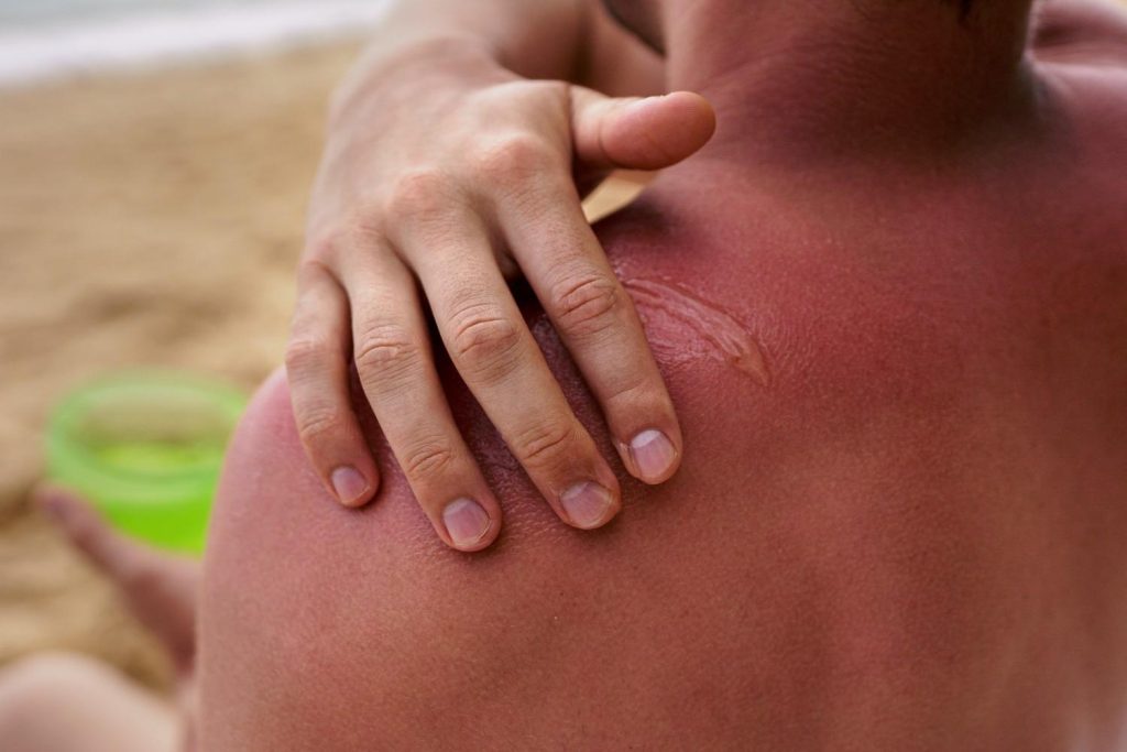 Sunburn and sun damage during Qatar's summer