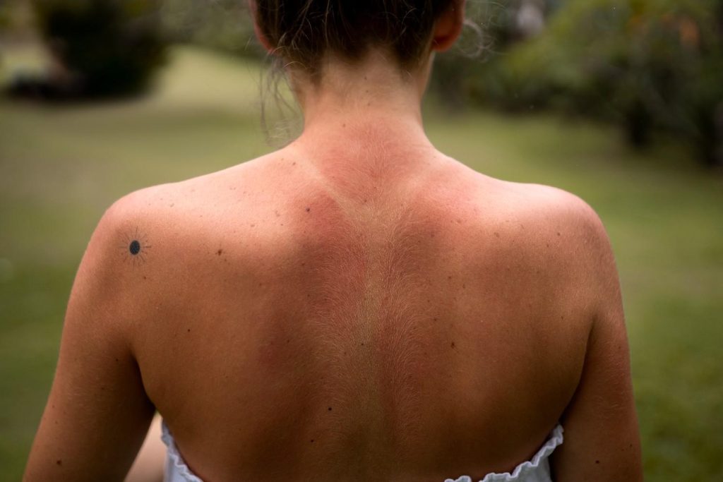 Sunburn and sun damage in Qatar