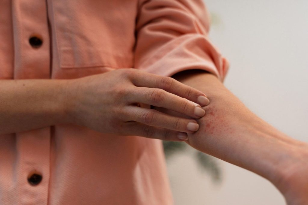 Prickly heat and heat rash in Qatar